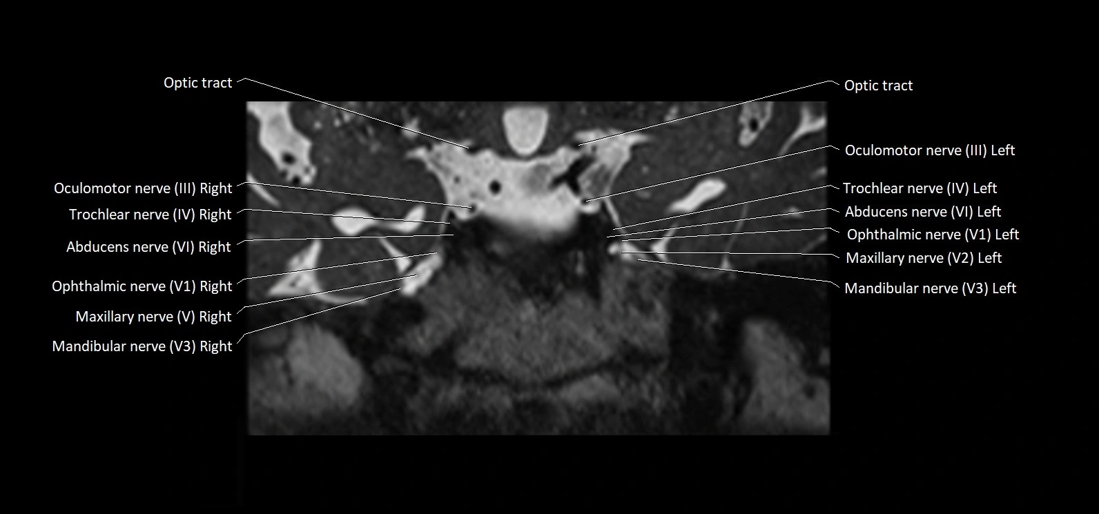 Cranial nerve cross sectional anatomy coronal 3T MRI image 33.webp